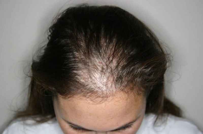 What illnesses cause hair loss in females