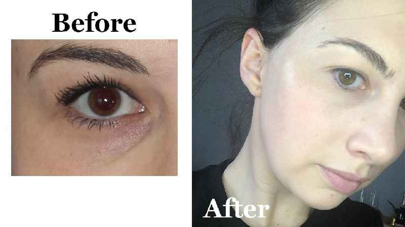 What injections are used for under eye bags