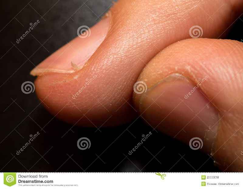 What is a hangnail