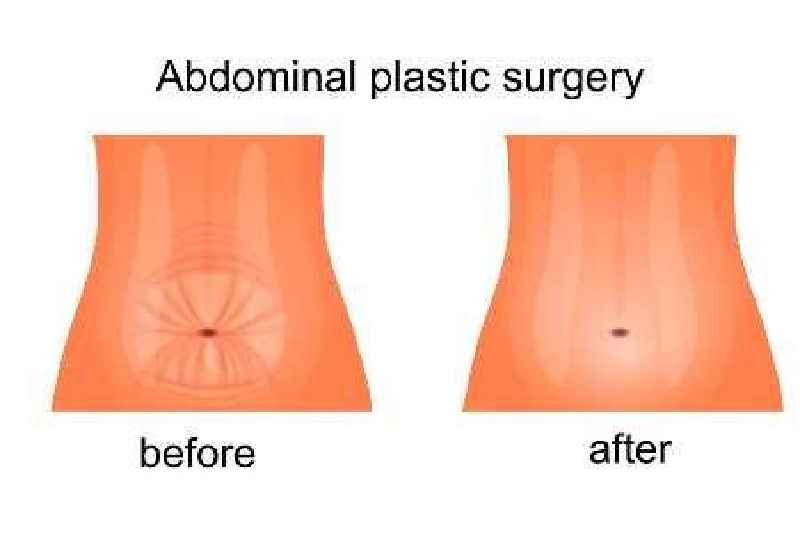 What is a medically necessary tummy tuck called