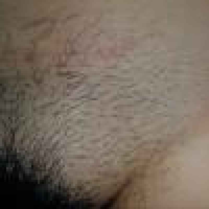 What is a permanent hair removal