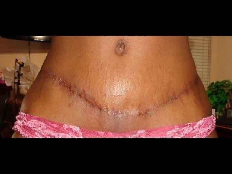 What is a plus size tummy tuck