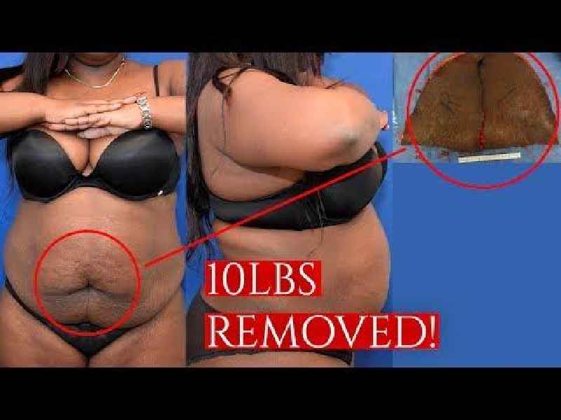 What is a plus size tummy tuck