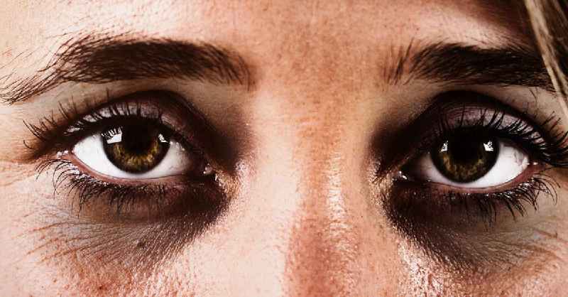 What is best for dark circles under eyes