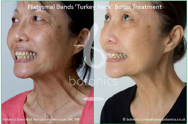 What is best treatment for turkey neck