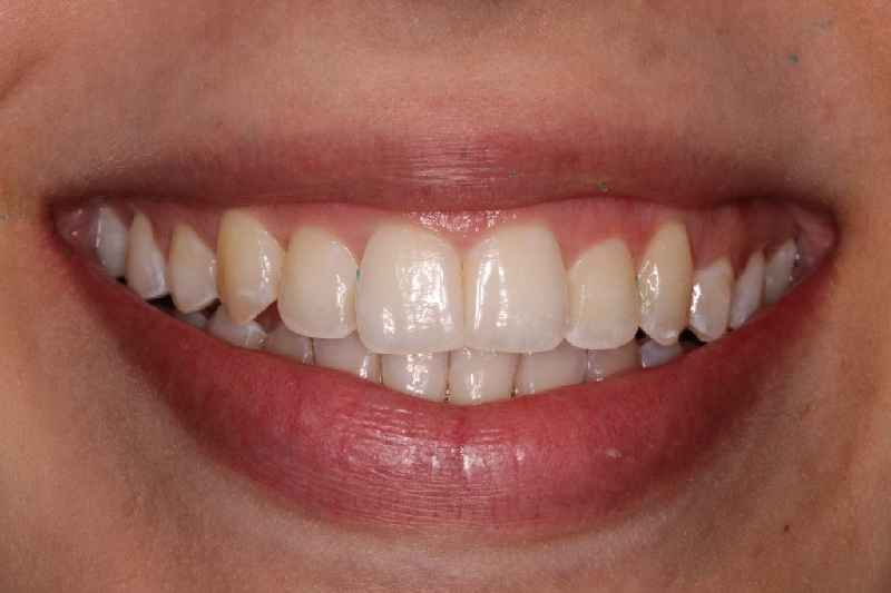 What is better braces or veneers