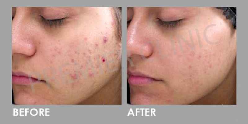 What is better chemical peel or microneedling