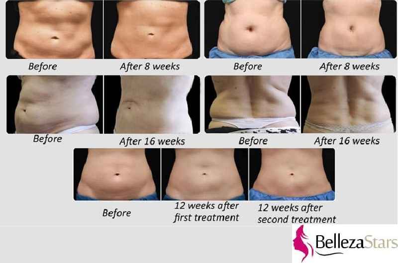 What is better CoolSculpting or lipo