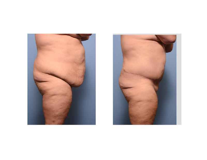 What is better CoolSculpting or tummy tuck