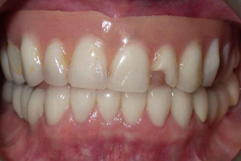 What is composite bonding on your teeth