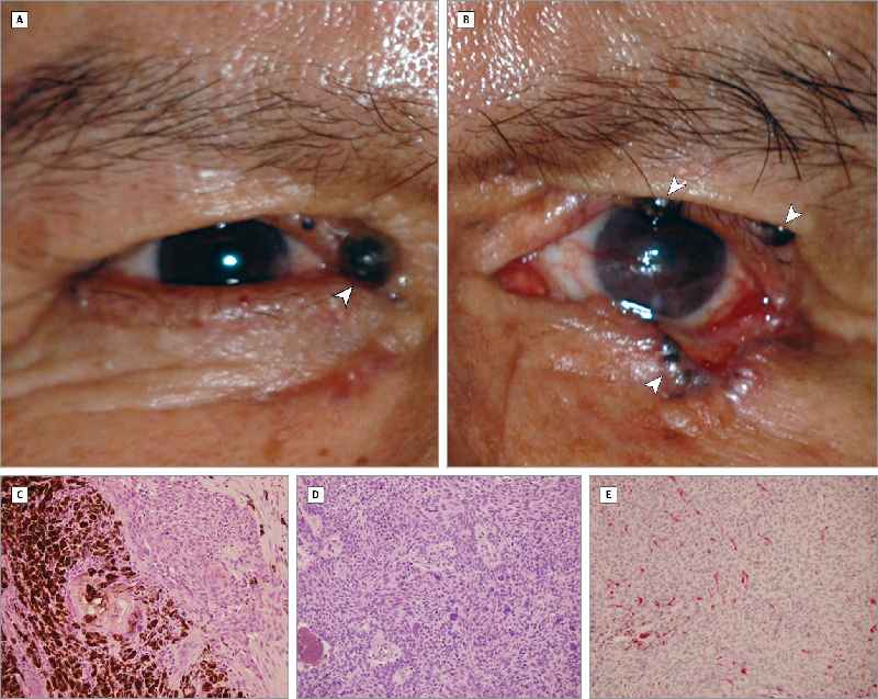 What is dermatochalasis of upper eyelids