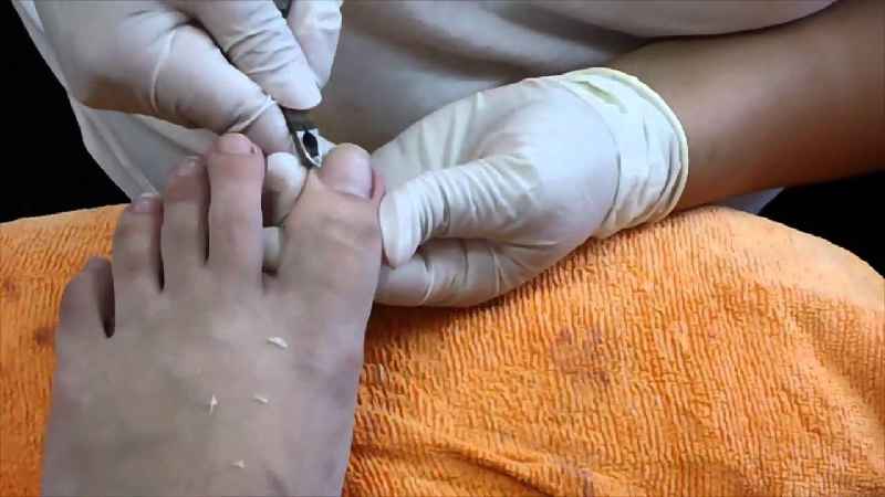 What is diabetic nail care