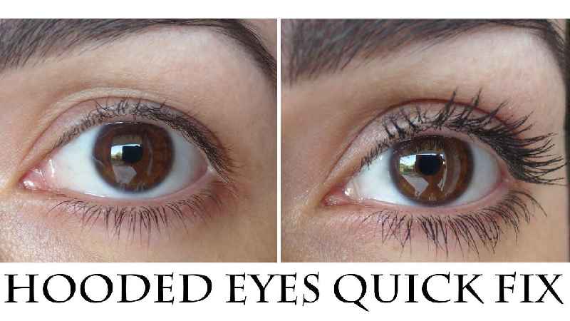 What is droopy eyelid surgery called