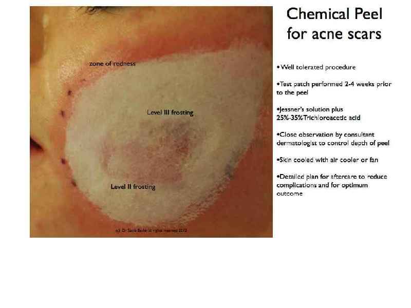 What is frosting during a chemical peel