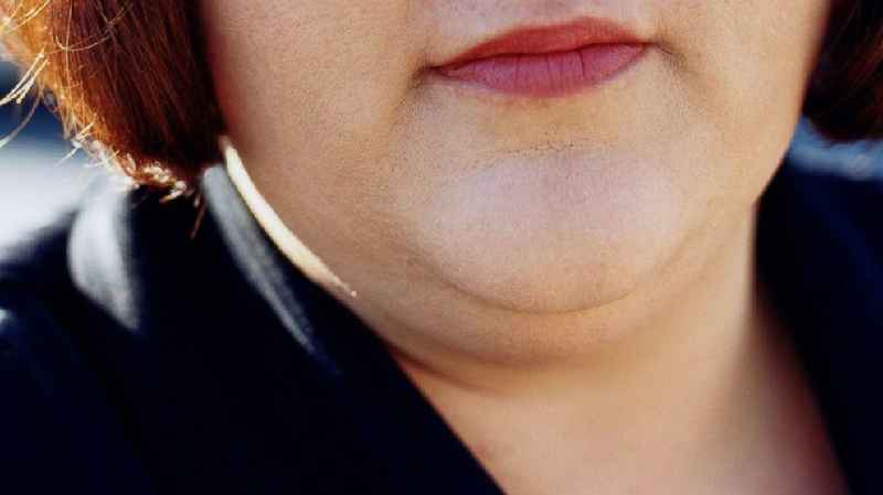 What is Kybella for double chin