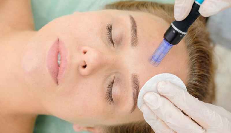 What is microneedling