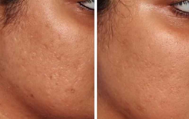 What is Microneedling with Sculptra
