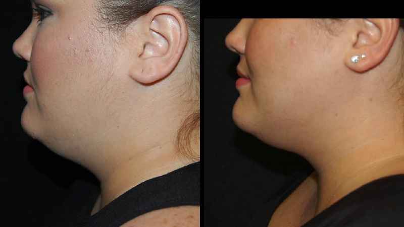 What is more effective Kybella or CoolSculpting