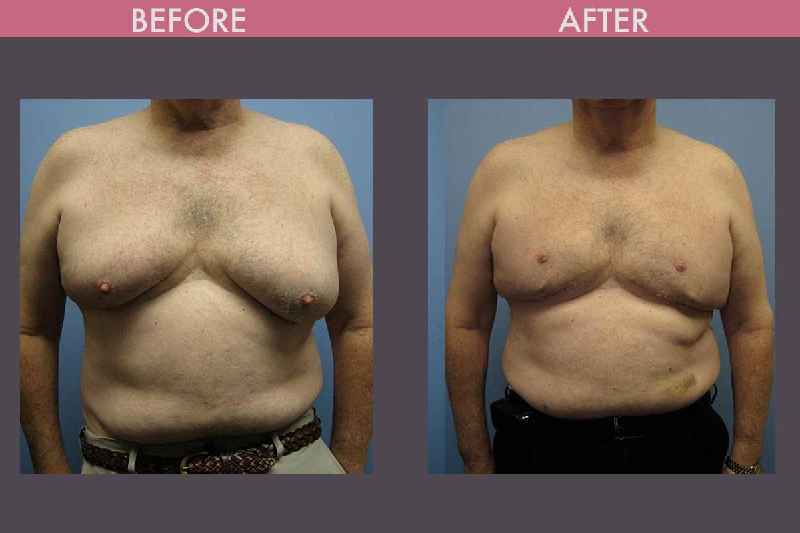 What is plastic surgery for love handles called