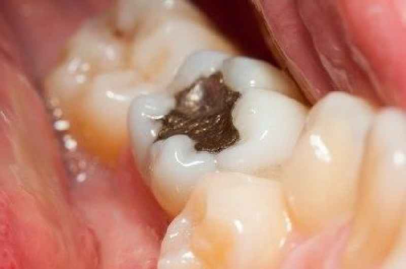 What is root canal of teeth