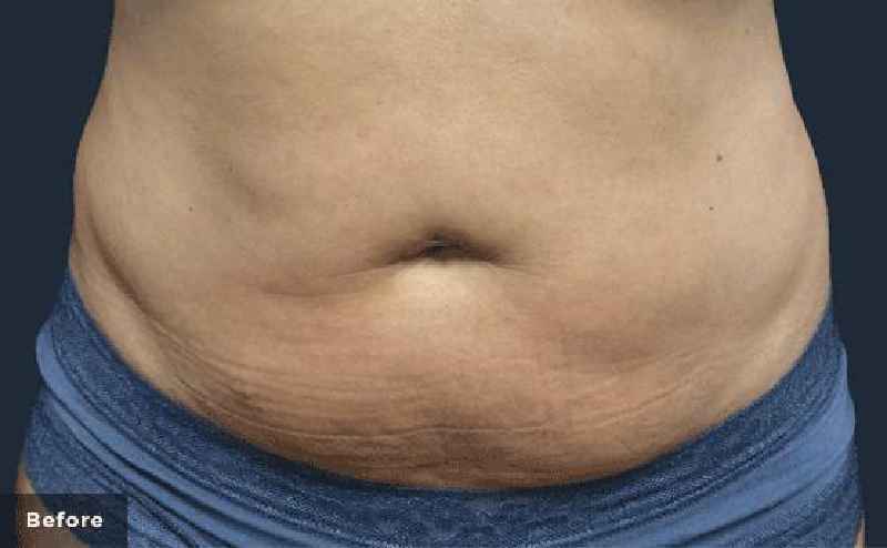 What is stomach reduction surgery called