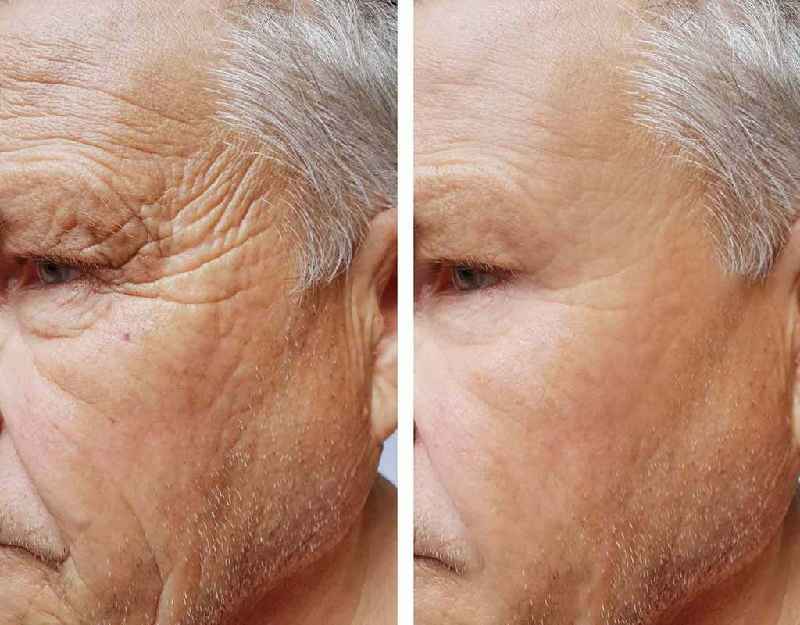 What is the best cosmetic procedure for wrinkles