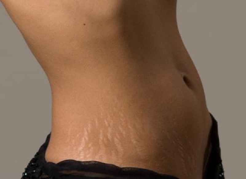 What is the best cosmetic treatment for stretch marks
