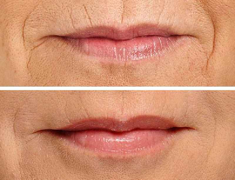 What is the best filler for wrinkles around the mouth