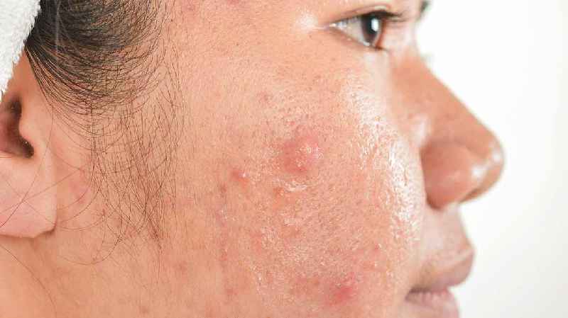 What is the best for acne
