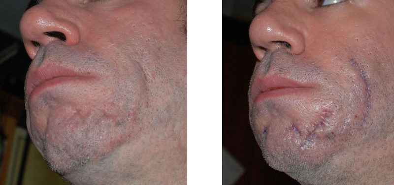 What is the best laser for scar removal