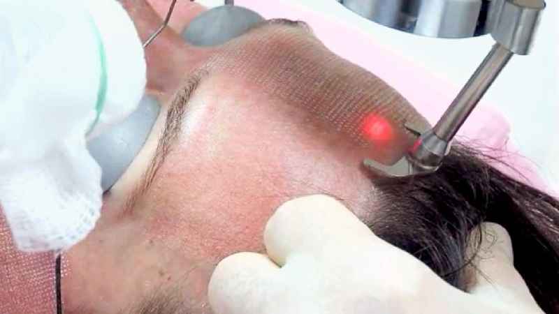 What is the best laser for skin resurfacing