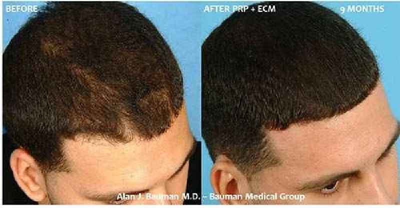 What is the best natural treatment for hair loss