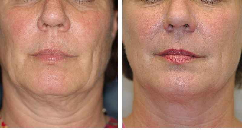 What is the best non invasive face lift