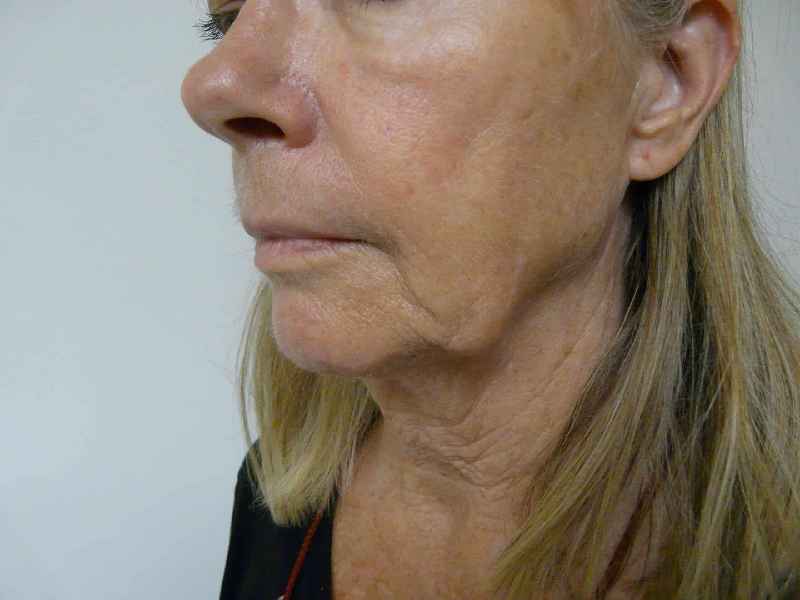 What is the best non surgical procedure for sagging jowls