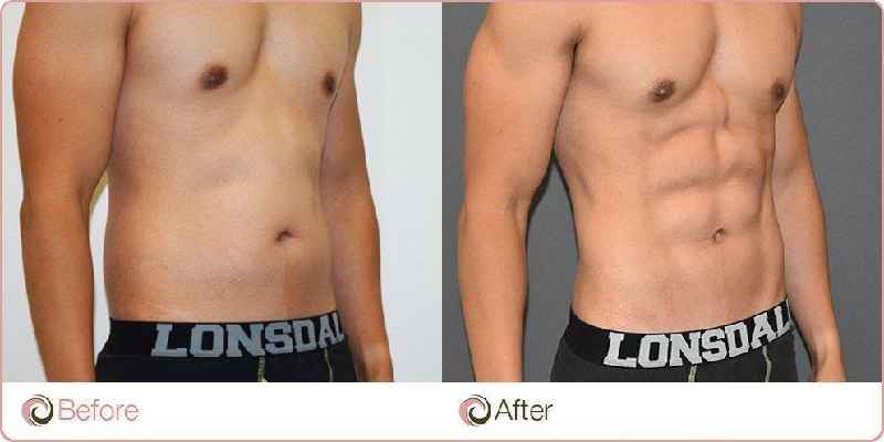 What is the best non surgical procedure to remove belly fat