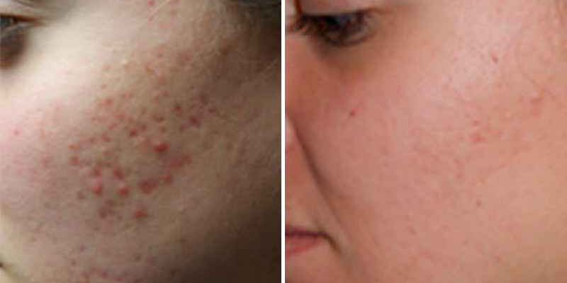 What is the best procedure to get rid of acne scars