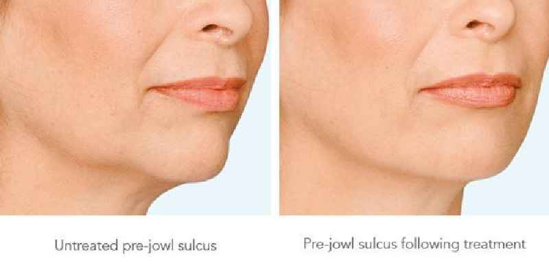 What is the best procedure to get rid of jowls