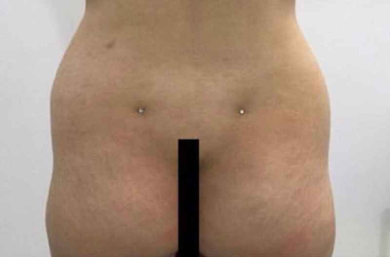 What is the best procedure to remove belly fat