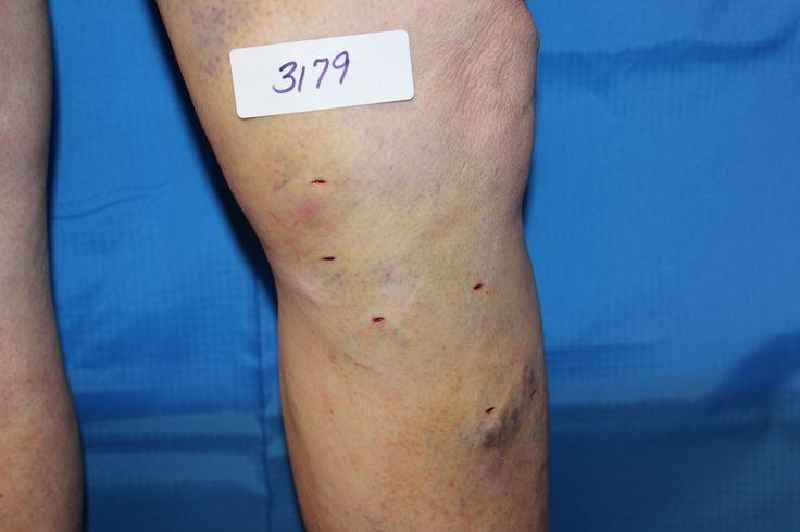 What is the best procedure to remove varicose veins