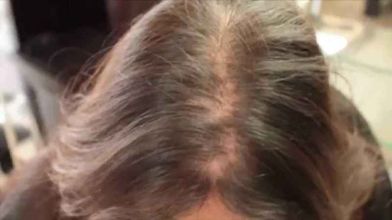What is the best supplement for female hair loss