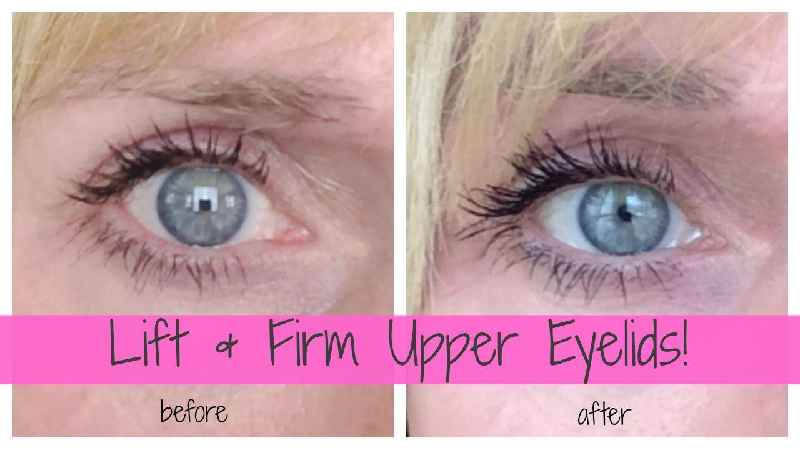 What is the best treatment for hooded eyelids