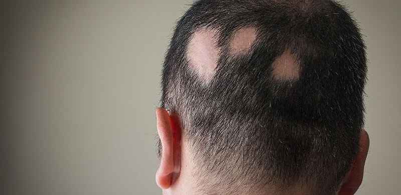 What is the best treatment for male hair loss