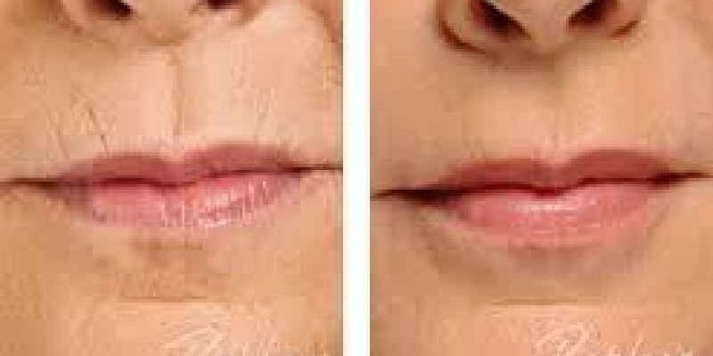 What is the best treatment for smokers lip lines