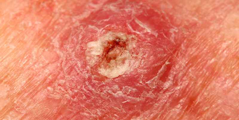 What is the best treatment for squamous cell carcinoma
