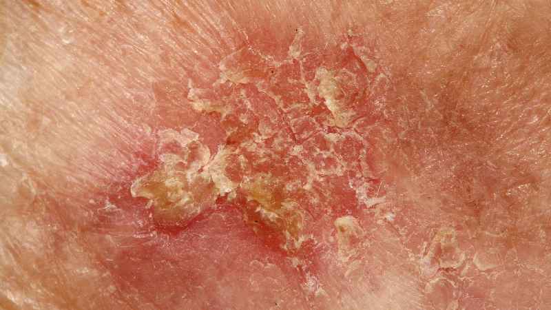 What is the best treatment for squamous cell carcinoma in situ