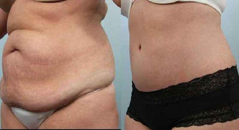 What is the best type of tummy tuck