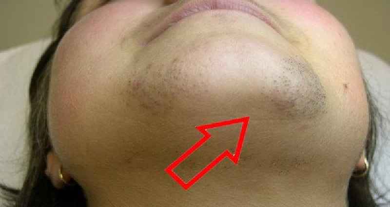 What is the best way to permanently remove facial hair