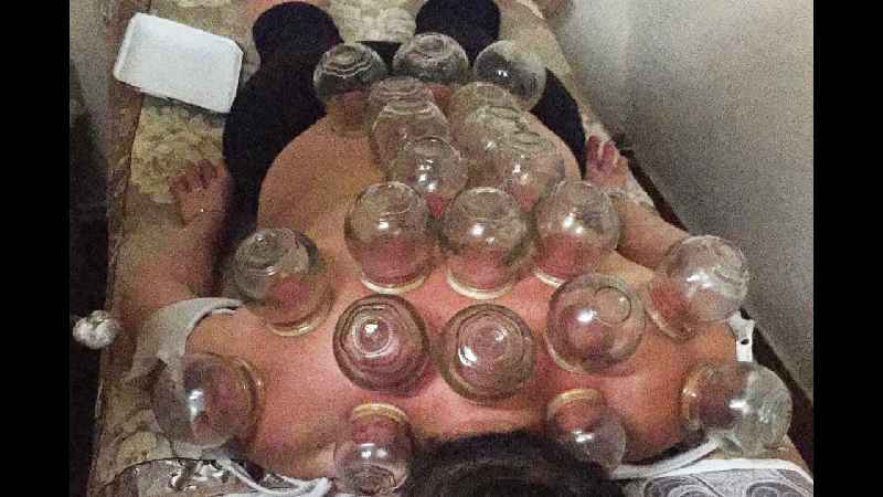 What is the cost of cupping therapy