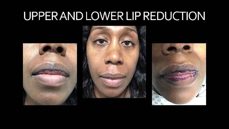 What is the cost of lip surgery in India