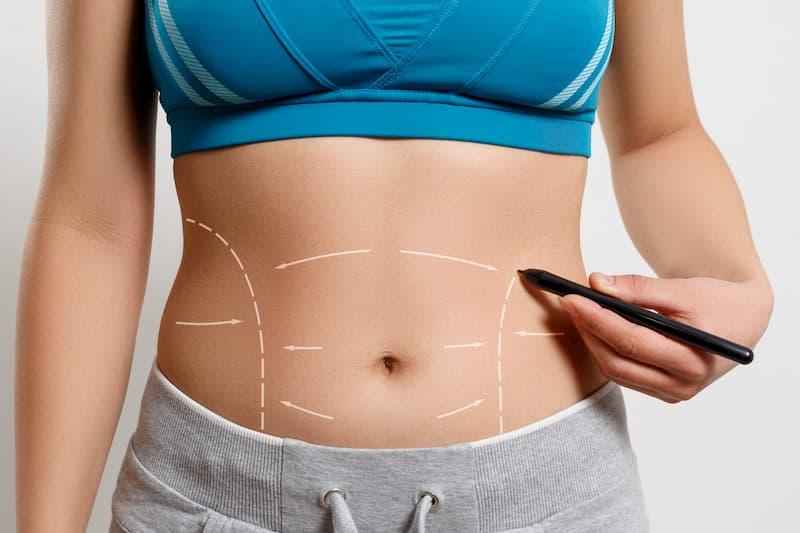 What is the difference between a Drainless and a tummy tuck